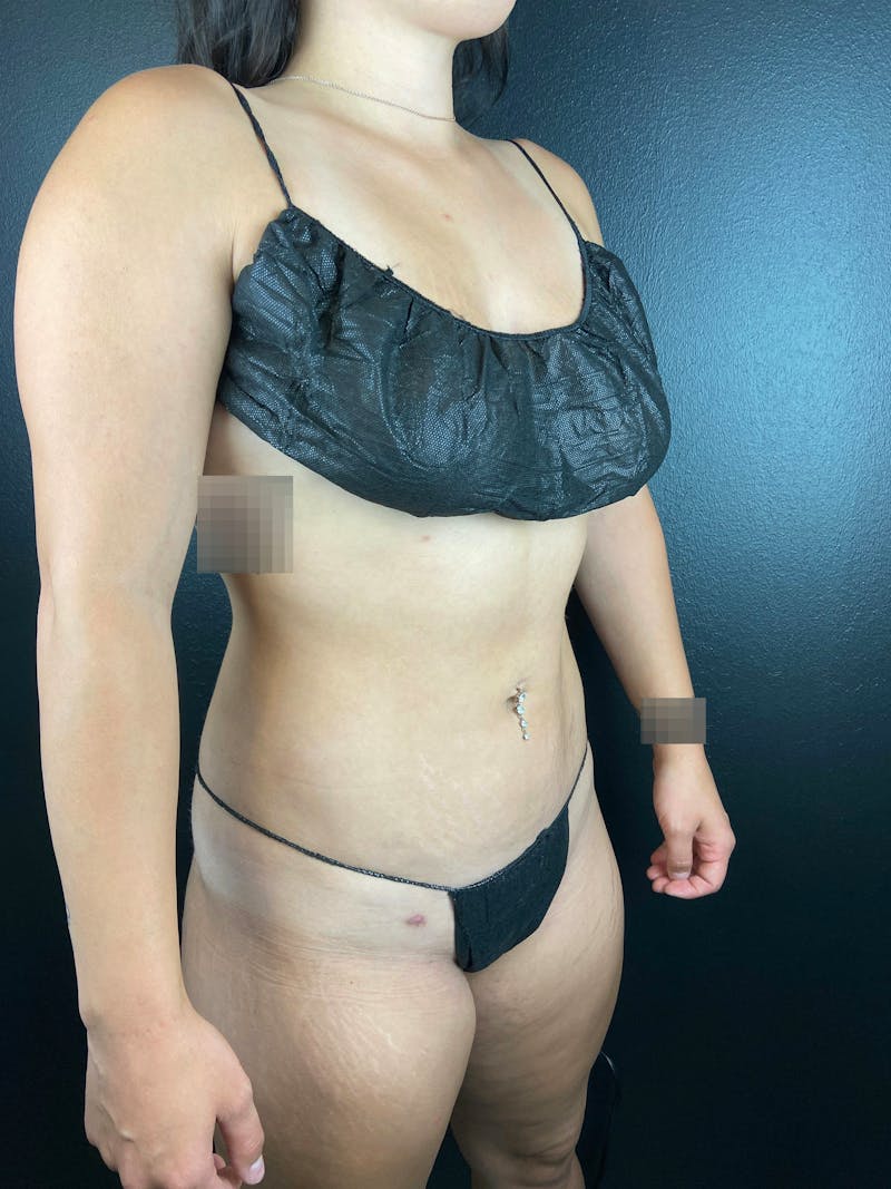 Abdomen (Liposuction) Before & After Gallery - Patient 169978 - Image 4