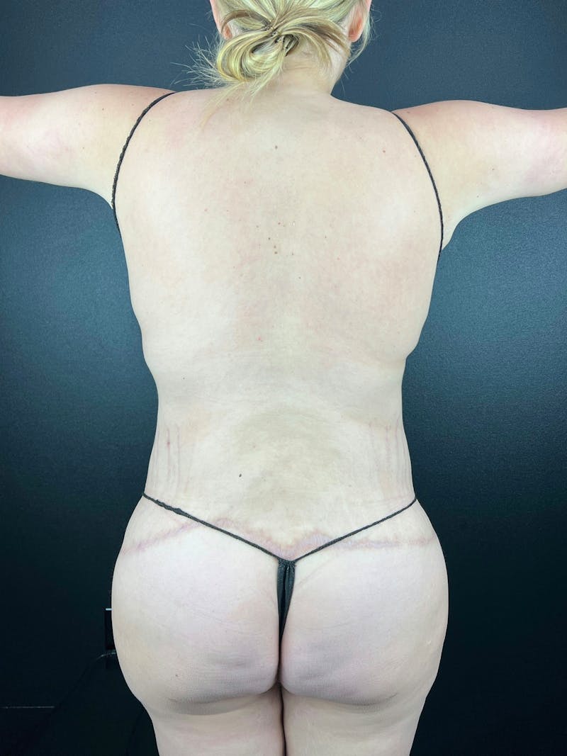 BBL + Aveli  Before & After Gallery - Patient 183275 - Image 2