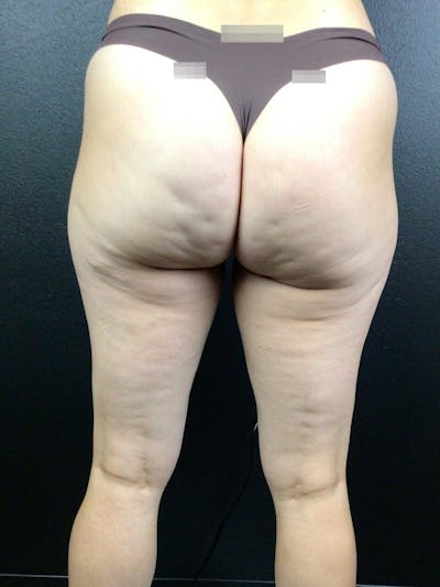 BBL + Aveli  Before & After Gallery - Patient 114492 - Image 1