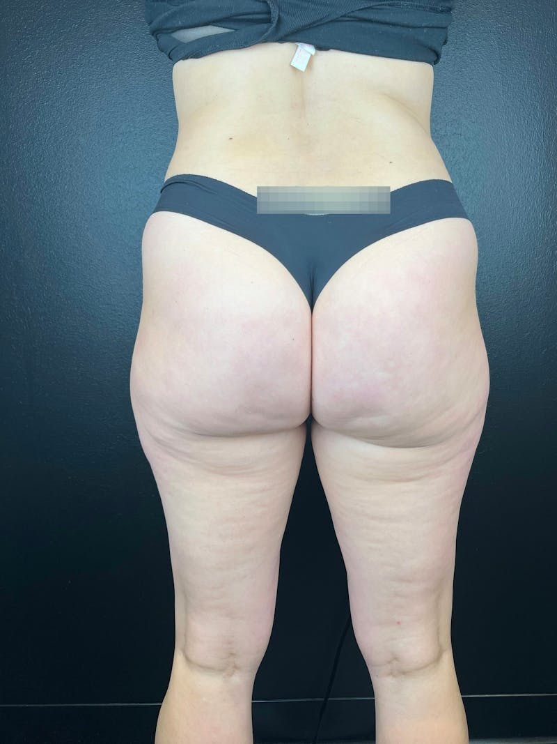 BBL + Aveli  Before & After Gallery - Patient 114492 - Image 2