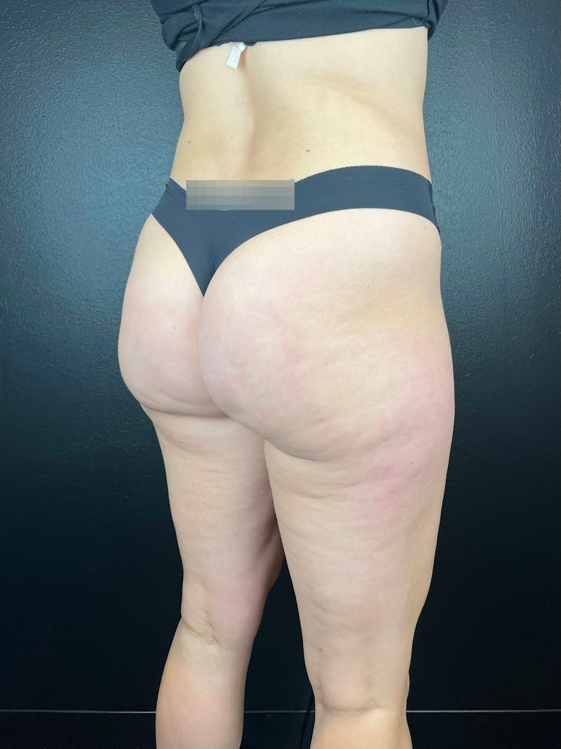 BBL + Aveli  Before & After Gallery - Patient 114492 - Image 4