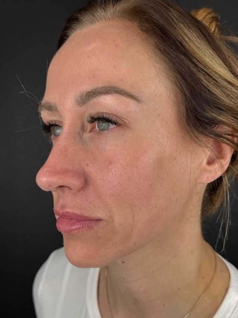 Rhinoplasty Before & After Gallery - Patient 150884 - Image 2