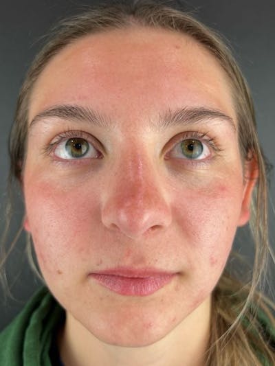 Rhinoplasty Before & After Gallery - Patient 242615 - Image 2