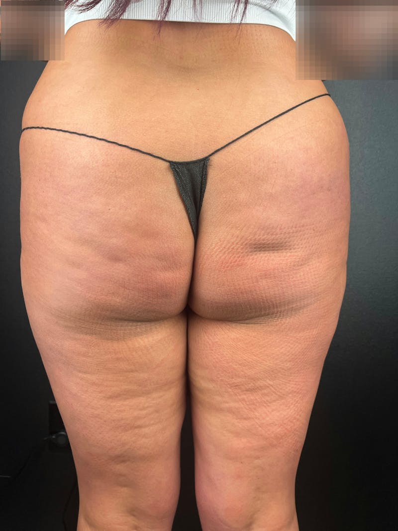 BBL + Aveli  Before & After Gallery - Patient 249237 - Image 1