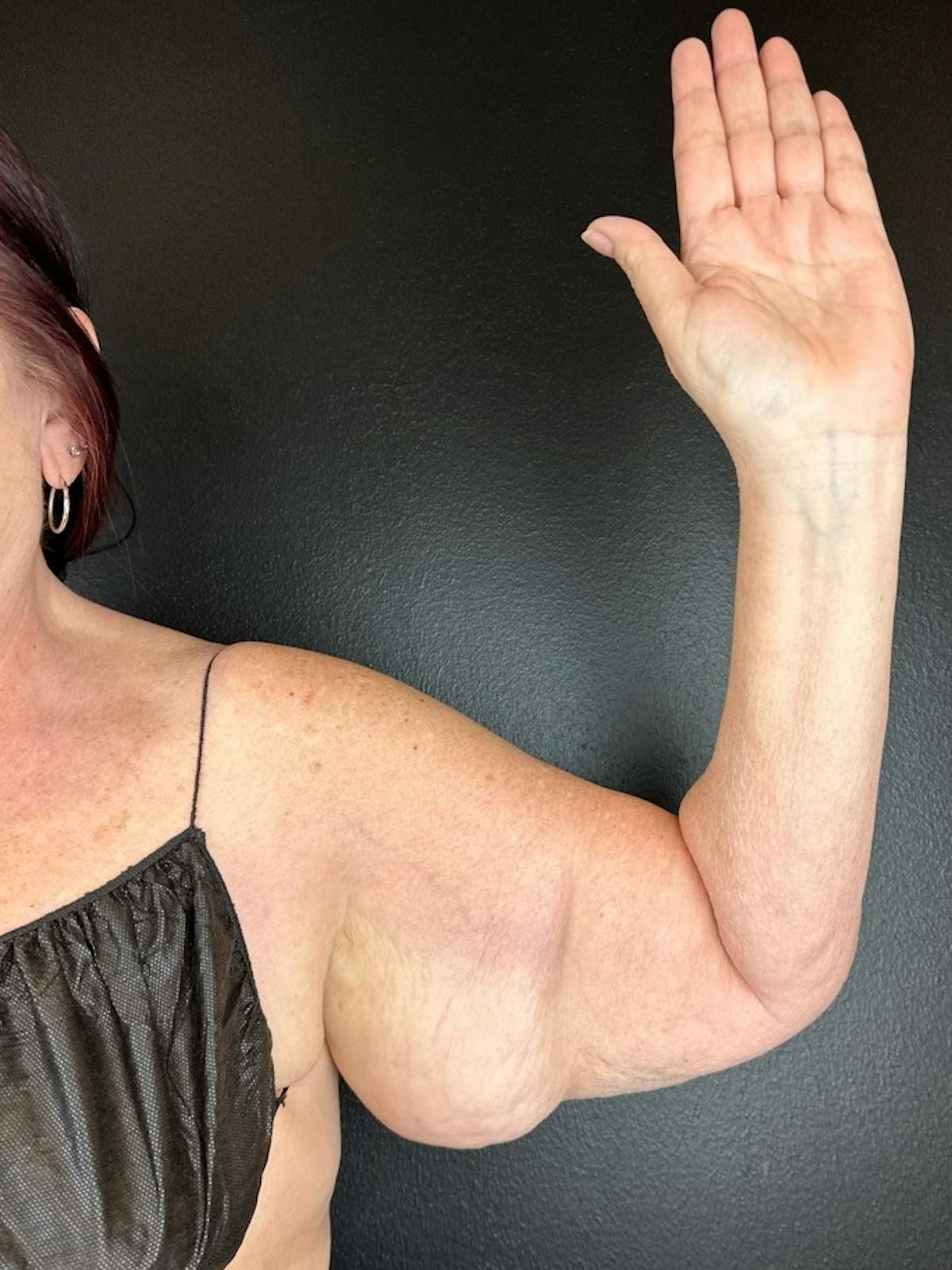 Arms (Brachioplasty) Before & After Gallery - Patient 962910 - Image 1