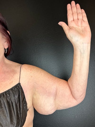 Arms (Brachioplasty) Before & After Gallery - Patient 962910 - Image 1