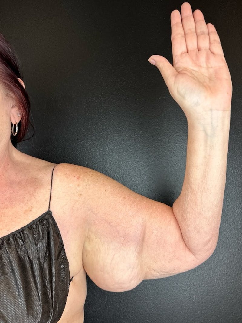 Arm Lift Before & After Gallery - Patient 573246 - Image 1