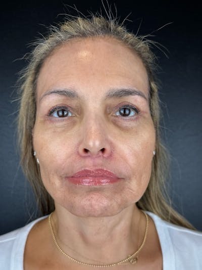 Lip Lift Before & After Gallery - Patient 612378 - Image 2