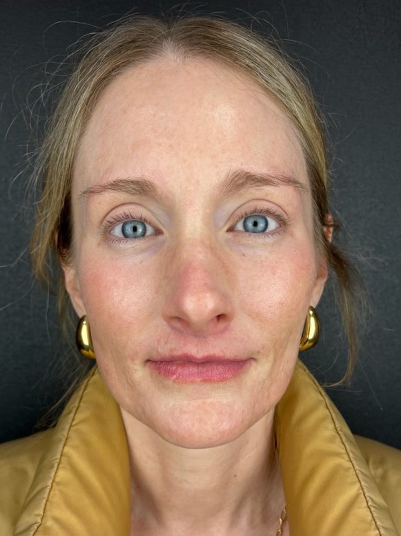Lip Lift Before & After Gallery - Patient 329839 - Image 2
