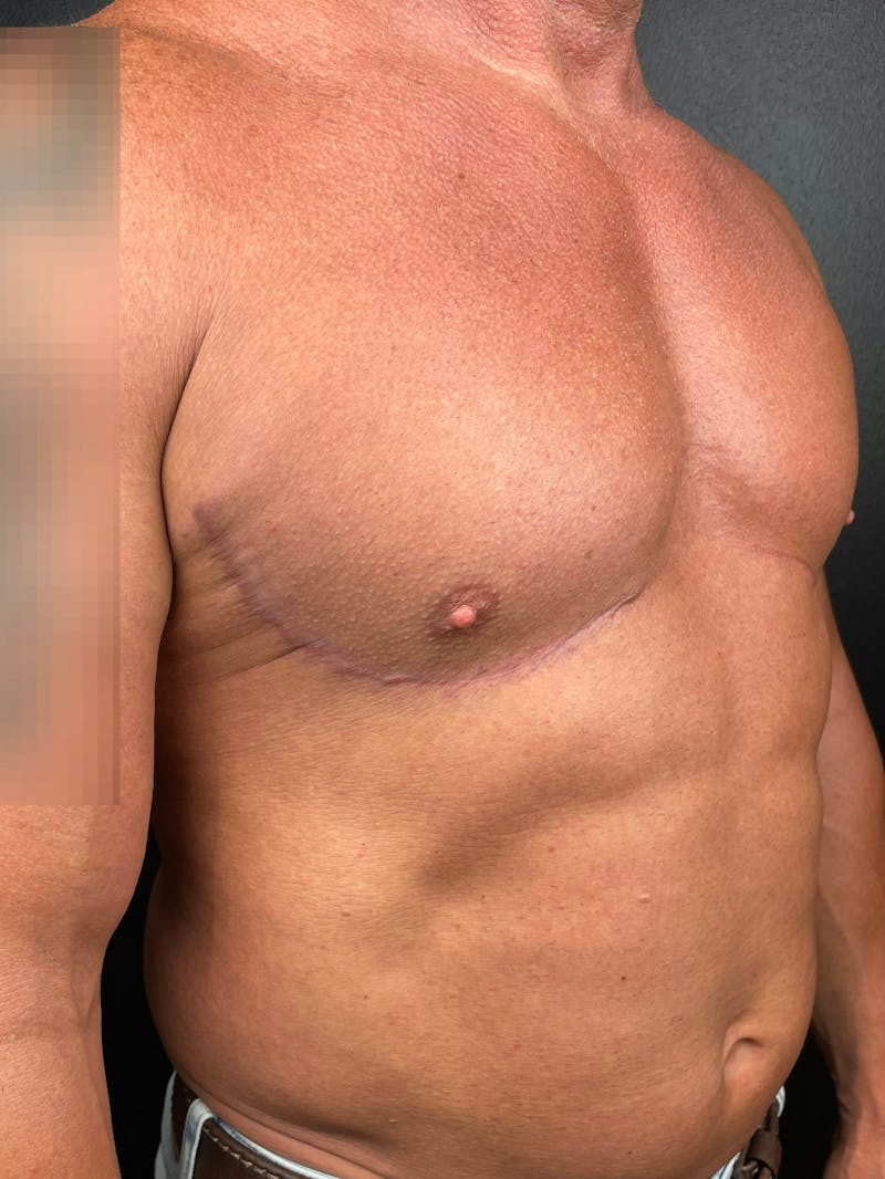 Gynecomastia Before & After Gallery - Patient 283886 - Image 4