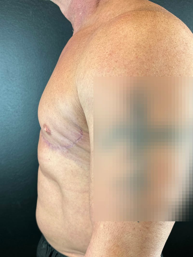 Gynecomastia Before & After Gallery - Patient 283886 - Image 2