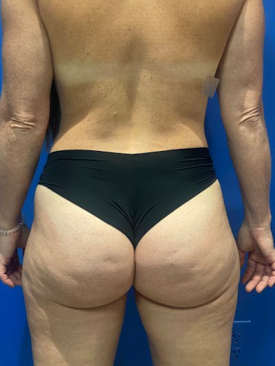 BBL + Aveli  Before & After Gallery - Patient 111360 - Image 1