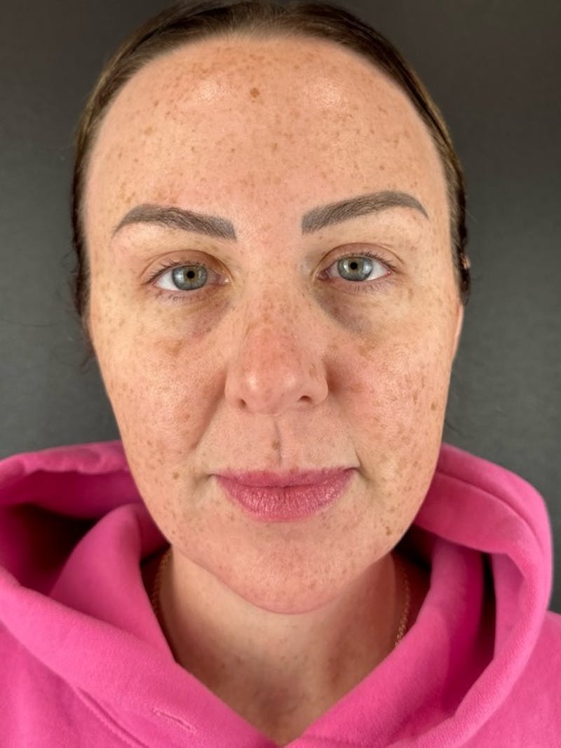 Lip Lift Before & After Gallery - Patient 148591 - Image 1