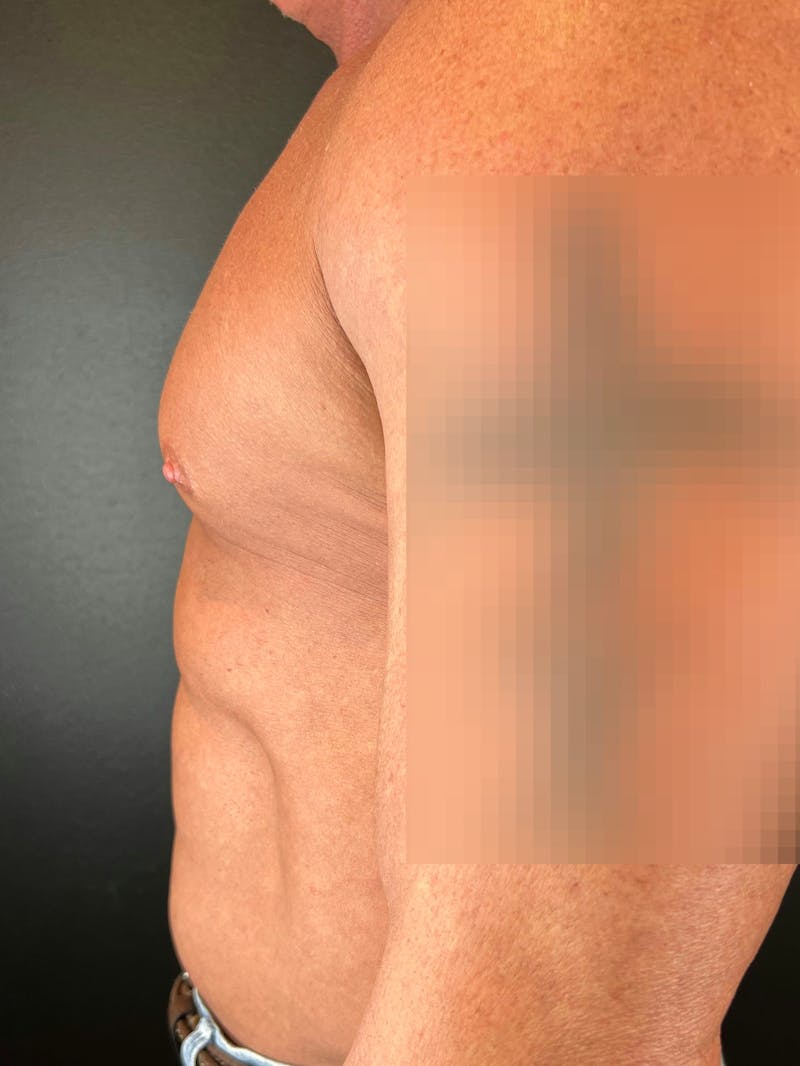Gynecomastia Before & After Gallery - Patient 283886 - Image 1
