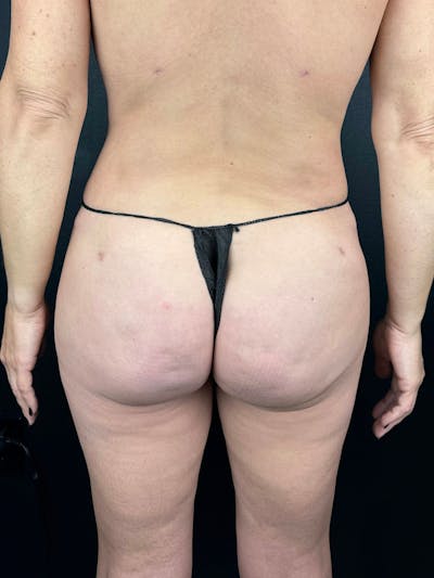 BBL + Aveli  Before & After Gallery - Patient 269778 - Image 2