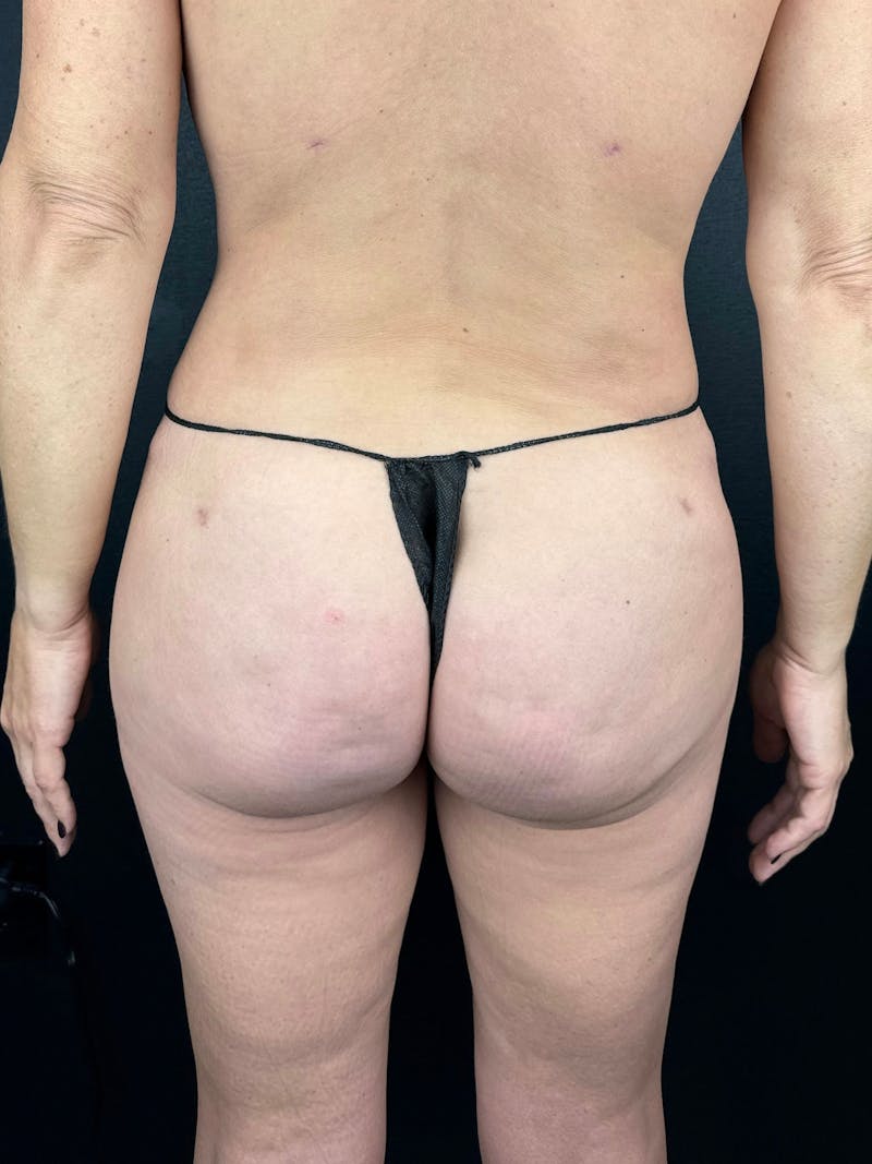BBL + Aveli  Before & After Gallery - Patient 269778 - Image 2