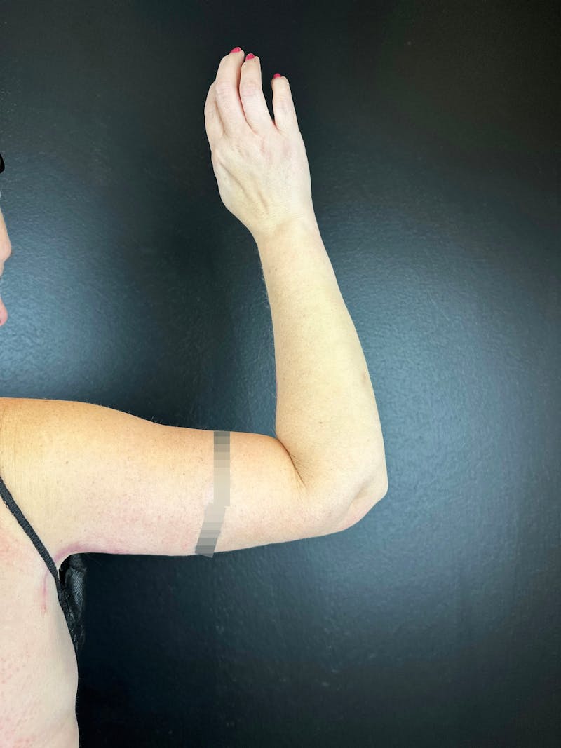 Arm Lift Before & After Gallery - Patient 222057 - Image 2