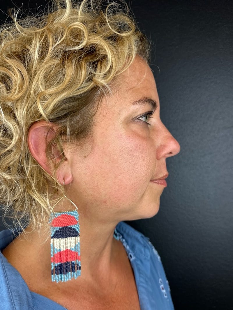 Blepharoplasty Before & After Gallery - Patient 492766 - Image 1