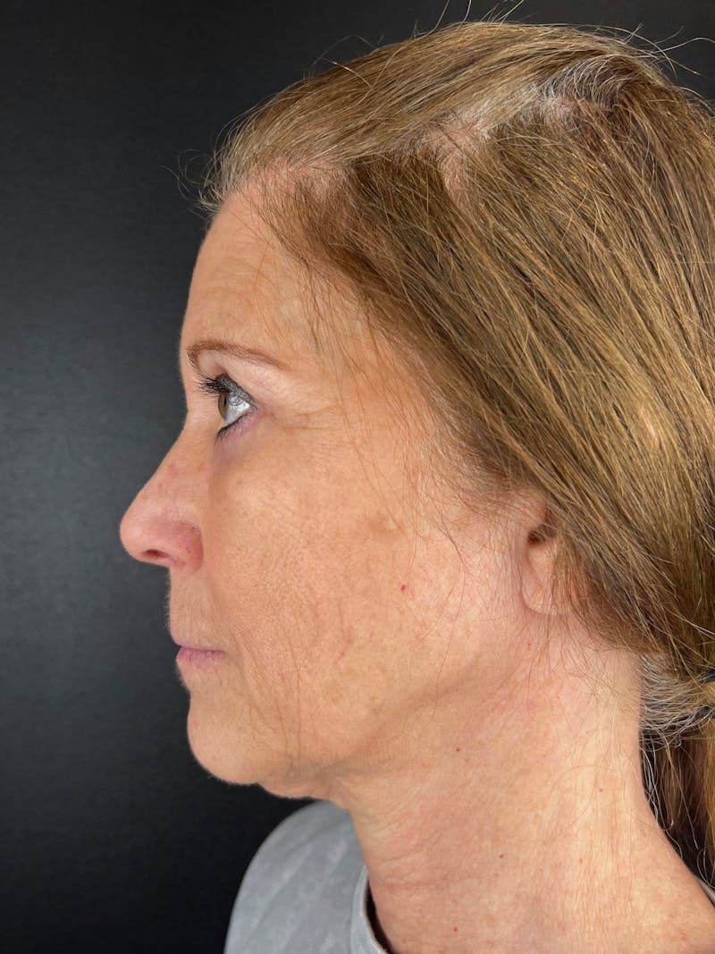 Blepharoplasty Before & After Gallery - Patient 399609 - Image 2