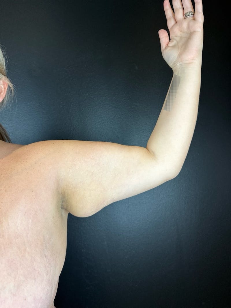 Arm Lift Before & After Gallery - Patient 423008 - Image 1