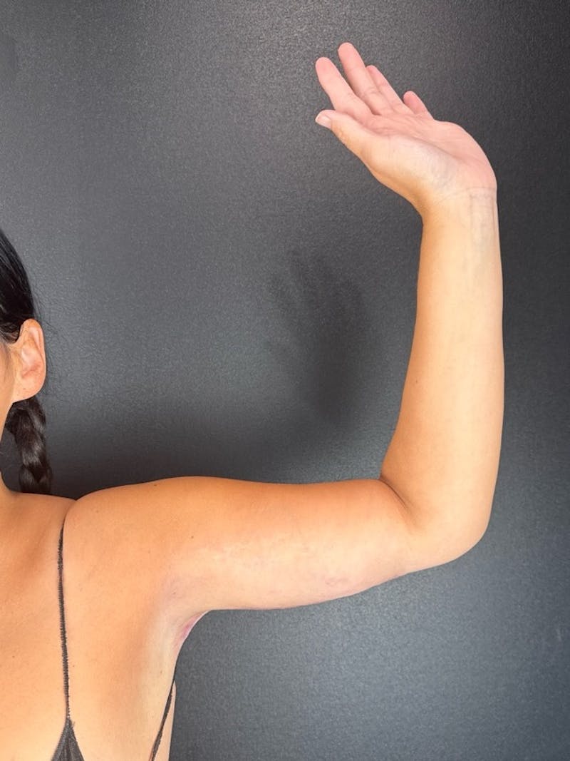 Arm Lift Before & After Gallery - Patient 714938 - Image 2