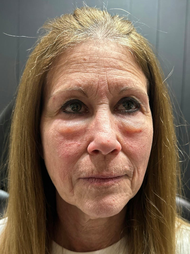 Blepharoplasty Before & After Gallery - Patient 283944 - Image 1