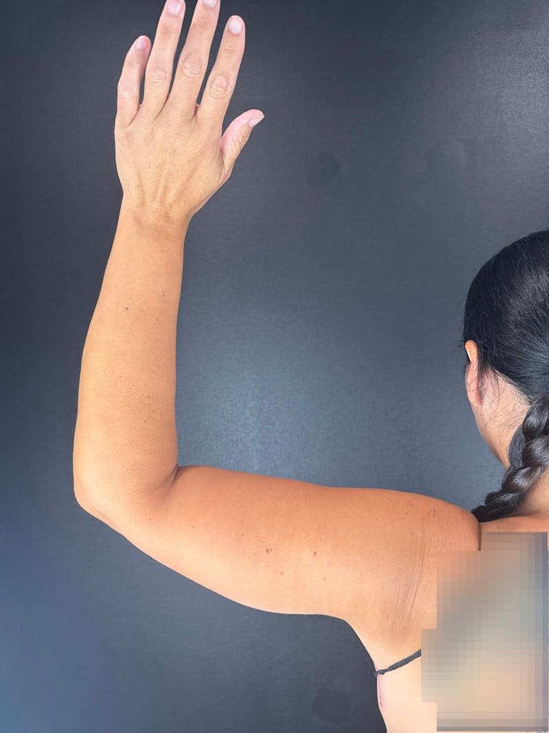 Arm Lift Before & After Gallery - Patient 304167 - Image 2
