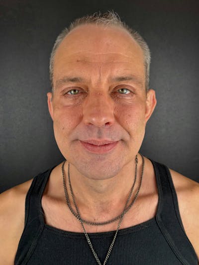 Blepharoplasty Before & After Gallery - Patient 363523 - Image 2