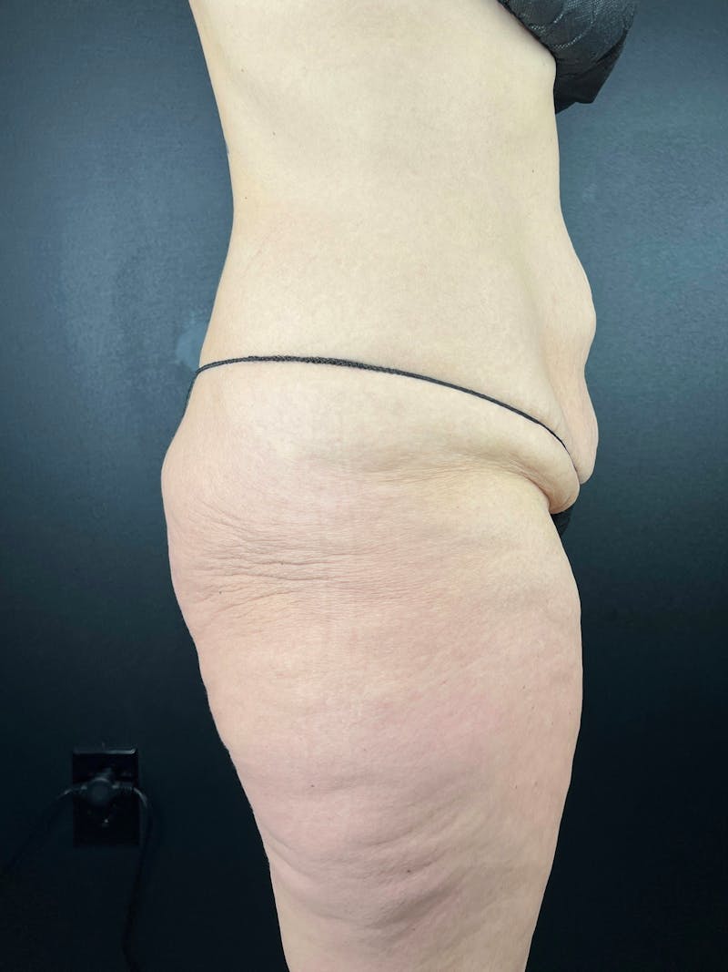 BBL + Aveli  Before & After Gallery - Patient 390052 - Image 1
