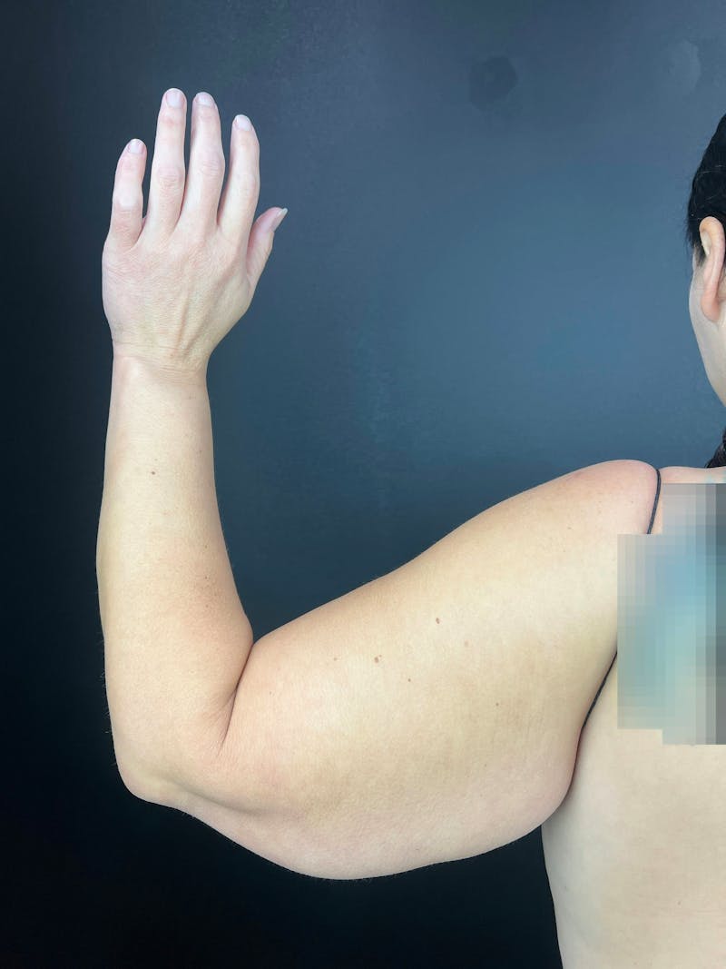 Arm Lift Before & After Gallery - Patient 304167 - Image 1