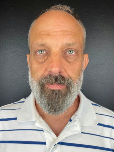 Blepharoplasty Before & After Gallery - Patient 363523 - Image 1