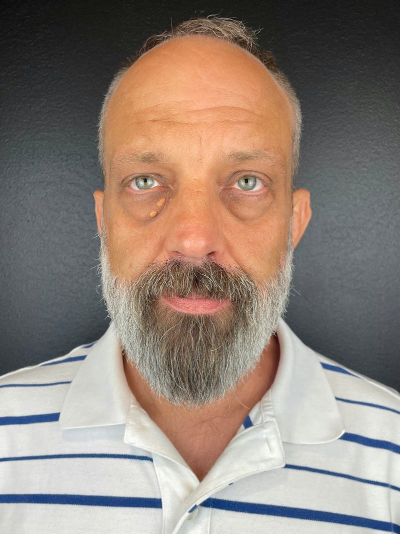 Blepharoplasty Before & After Gallery - Patient 363523 - Image 1