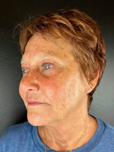 Blepharoplasty Before & After Gallery - Patient 314477 - Image 1