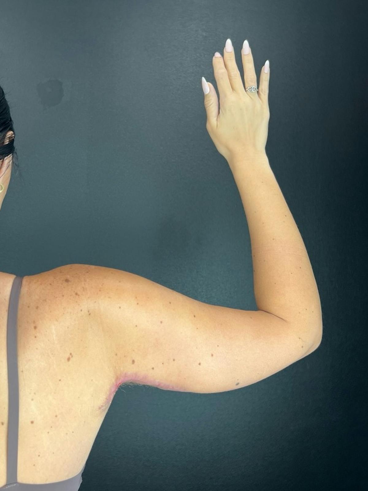 Arms (Brachioplasty) Before & After Gallery - Patient 279555 - Image 2