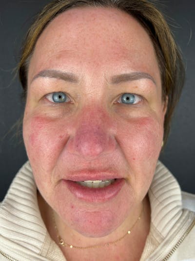 Blepharoplasty Before & After Gallery - Patient 424961 - Image 1