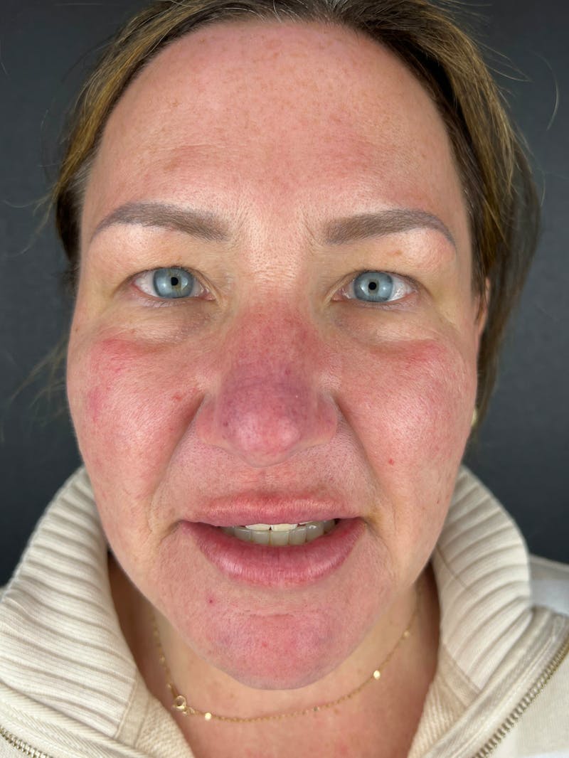 Blepharoplasty Before & After Gallery - Patient 424961 - Image 1