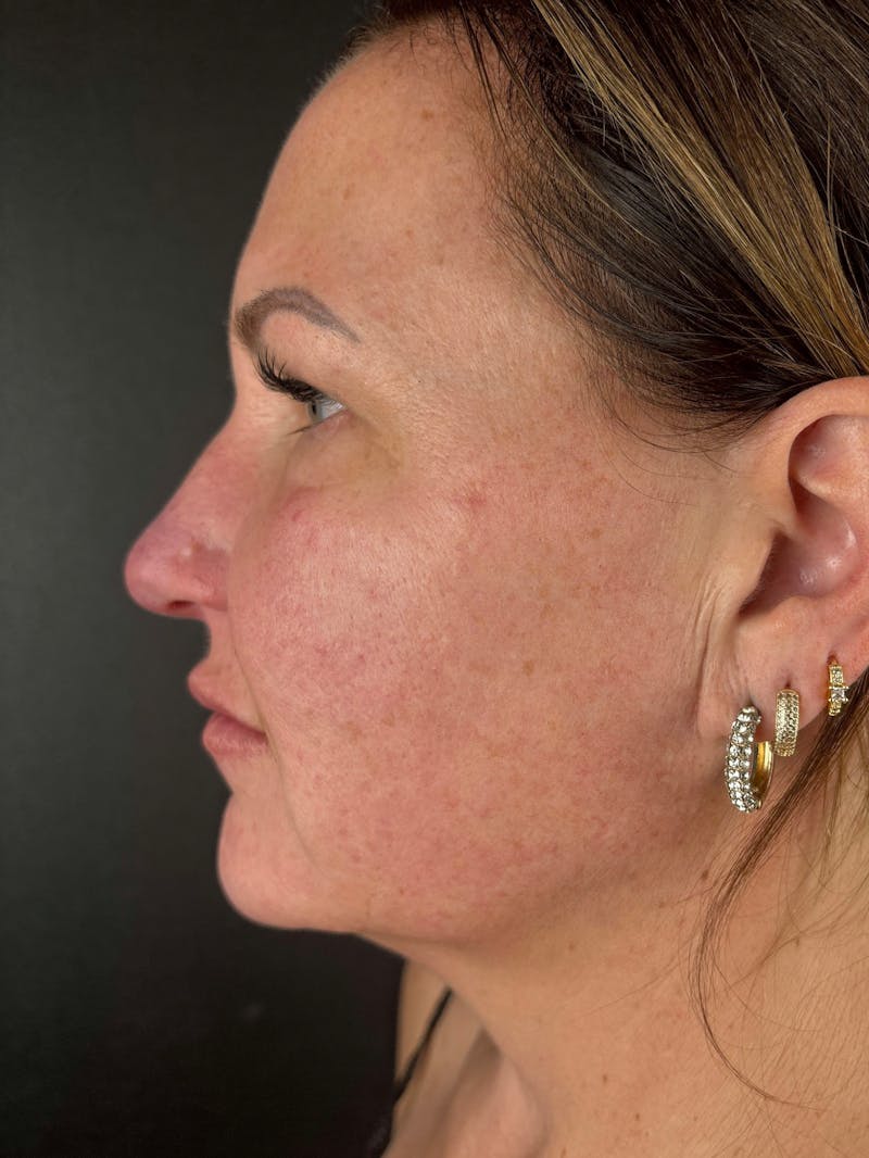 Blepharoplasty Before & After Gallery - Patient 424961 - Image 4