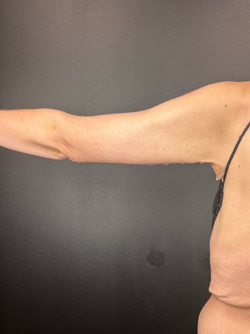 Arm Lift Before & After Gallery - Patient 411156 - Image 2