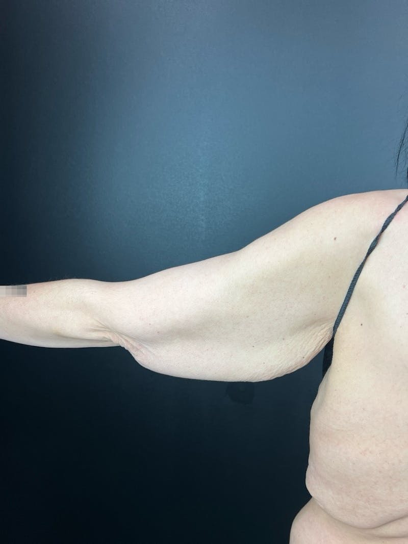 Arm Lift Before & After Gallery - Patient 411156 - Image 1