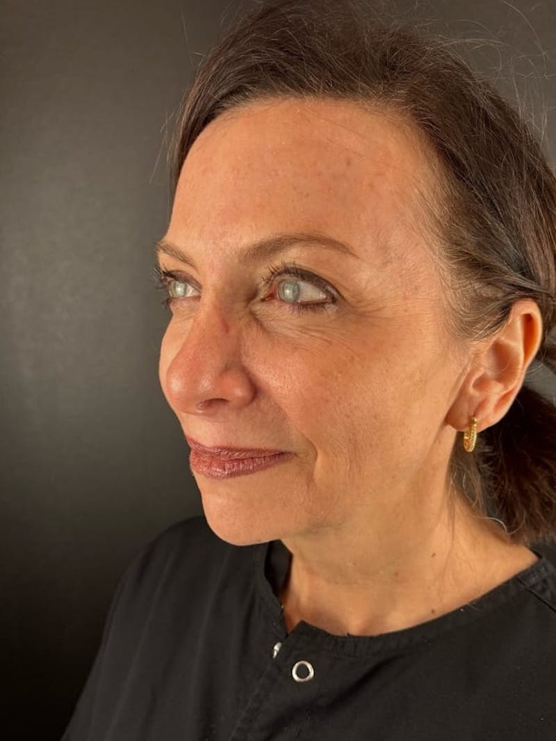 Blepharoplasty Before & After Gallery - Patient 350183 - Image 1
