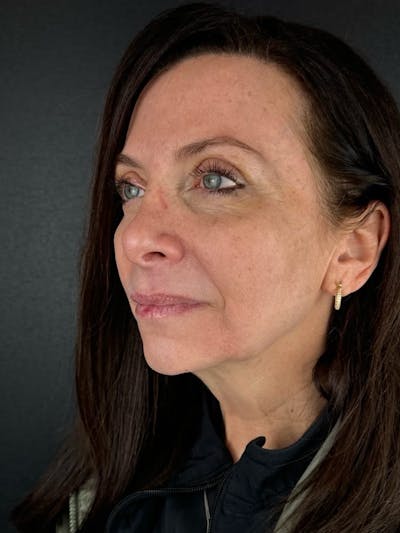 Blepharoplasty Before & After Gallery - Patient 350183 - Image 2