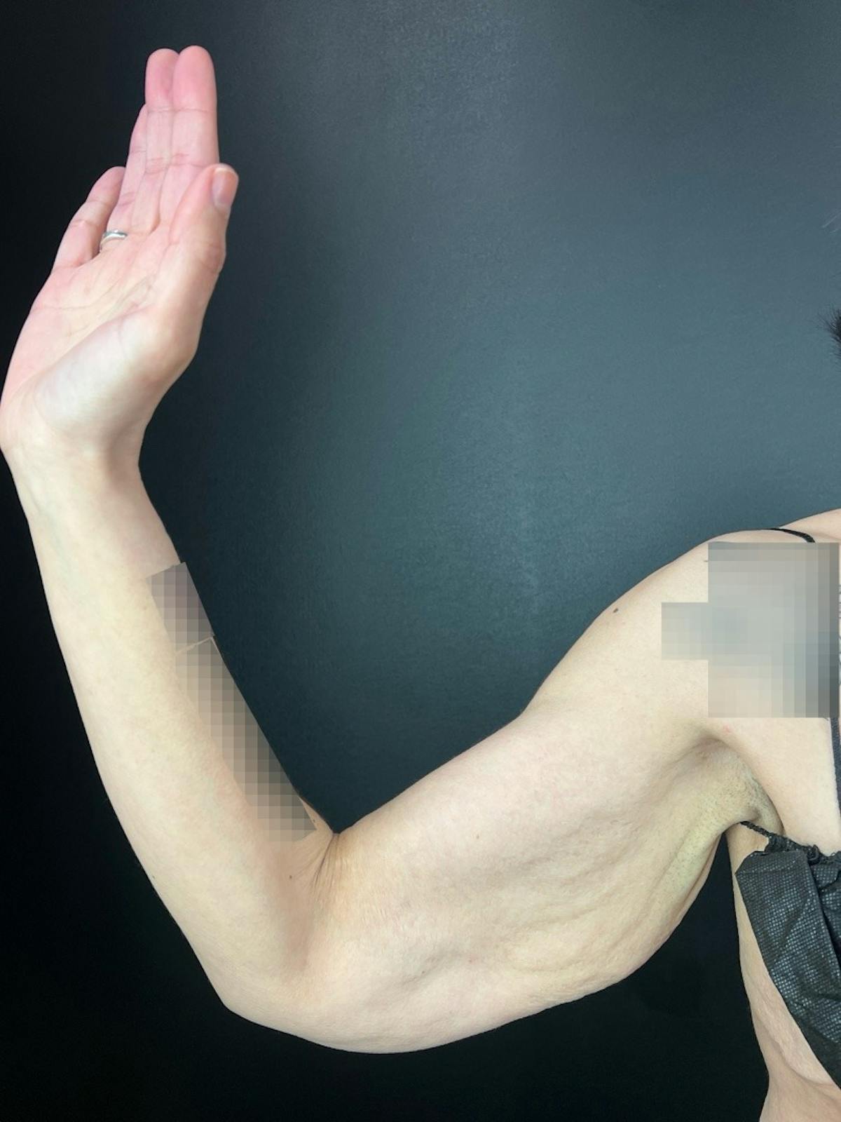 Arms (Brachioplasty) Before & After Gallery - Patient 277631 - Image 4
