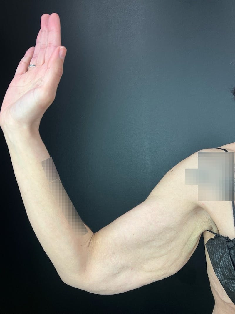 Arm Lift Before & After Gallery - Patient 411156 - Image 3