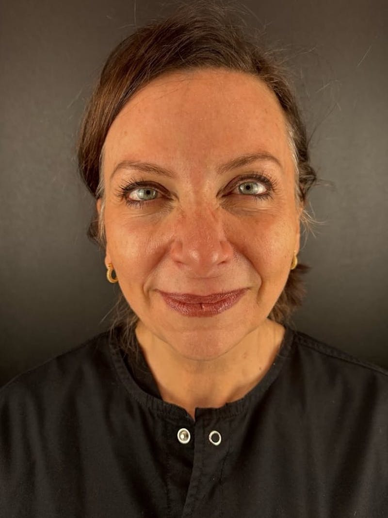 Blepharoplasty Before & After Gallery - Patient 350183 - Image 3