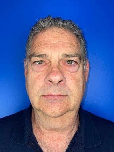 Blepharoplasty Before & After Gallery - Patient 152267 - Image 1