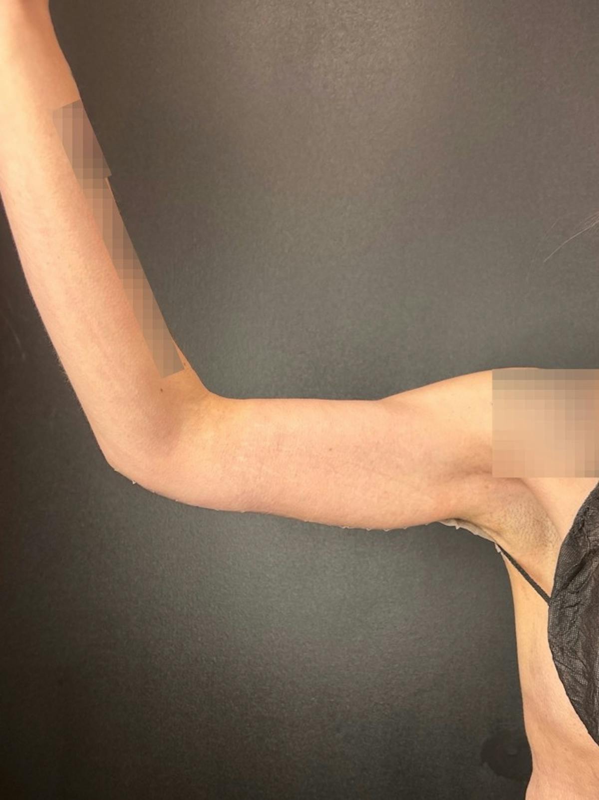 Arms (Brachioplasty) Before & After Gallery - Patient 277631 - Image 2