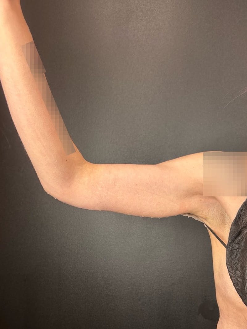 Arm Lift Before & After Gallery - Patient 411156 - Image 4