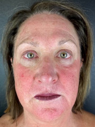 Blepharoplasty Before & After Gallery - Patient 366682 - Image 2