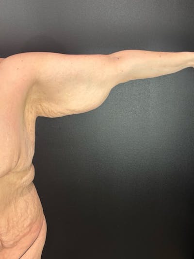 Arms (Brachioplasty) Before & After Gallery - Patient 140130 - Image 1
