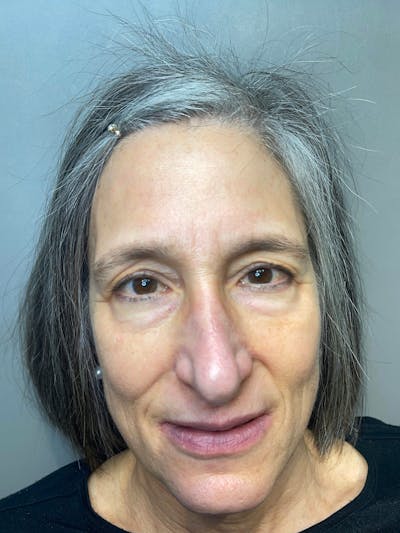 Blepharoplasty Before & After Gallery - Patient 645283 - Image 1